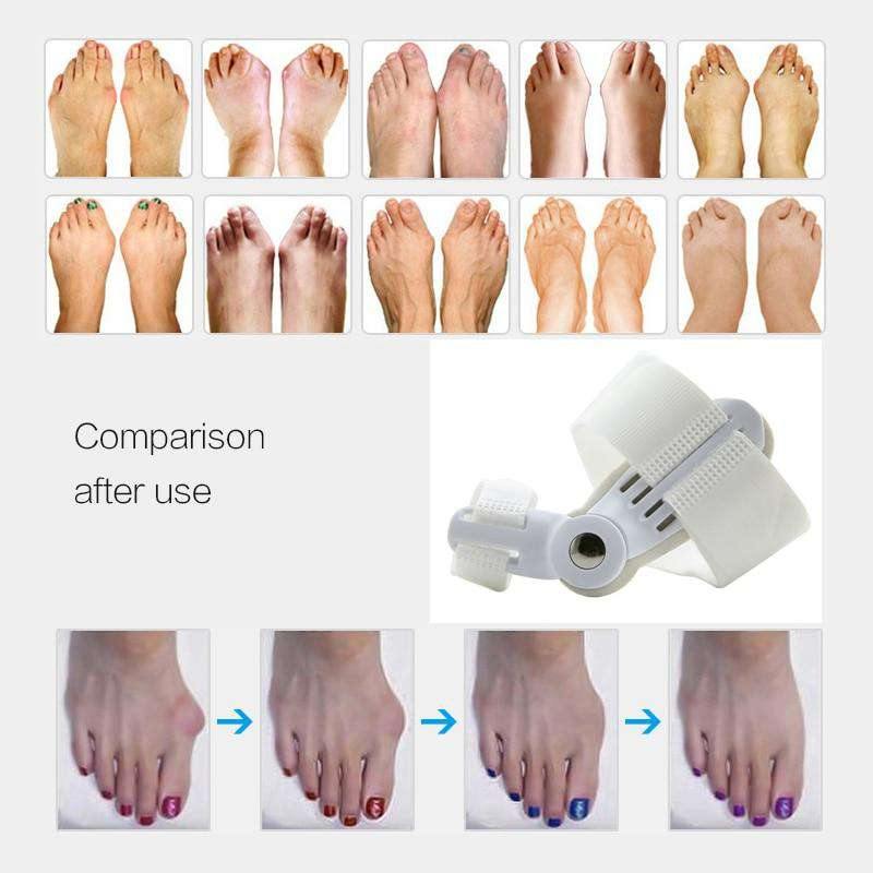 BESTWALK Orthopedic Bunion Corrector - Toe Splint Straightener - Summit MX Shop