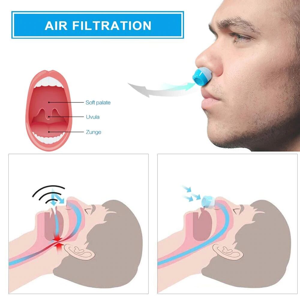 DAILY SUMMIT Anti Snore CPAP - Airing: Hoseless, Maskless, Micro-CPAP Anti Snoring Electronic Device